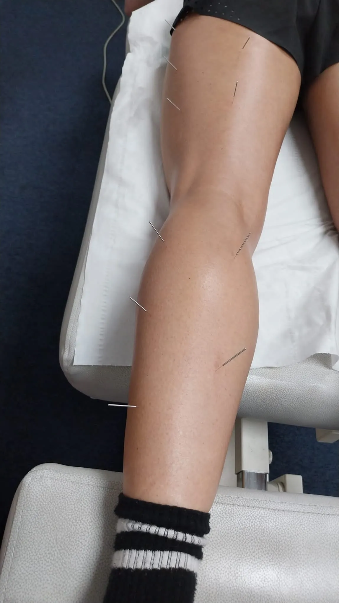 Patient's lower leg resting on a treatment couch before acupuncture