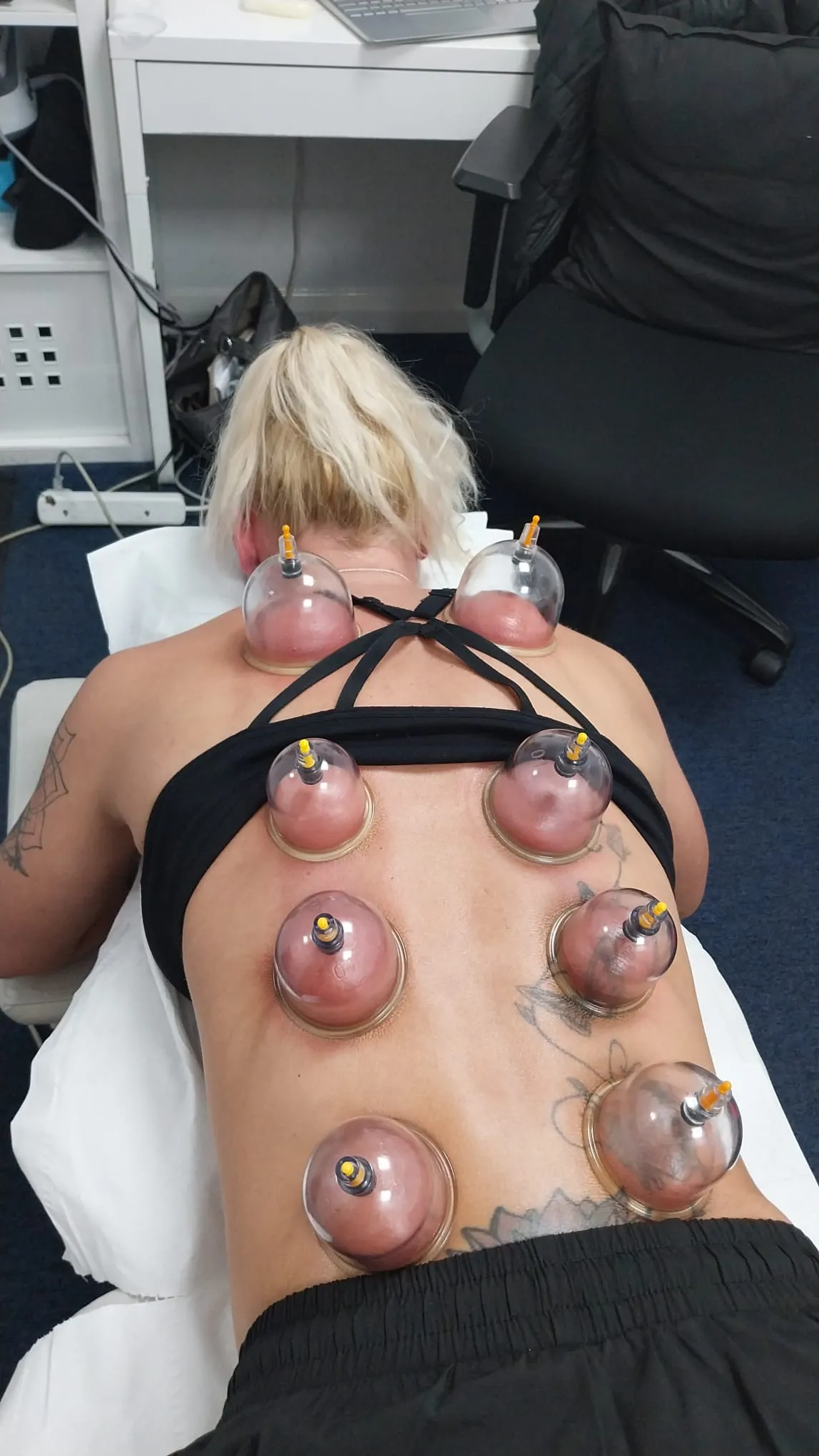 Cupping cups on a patient's back