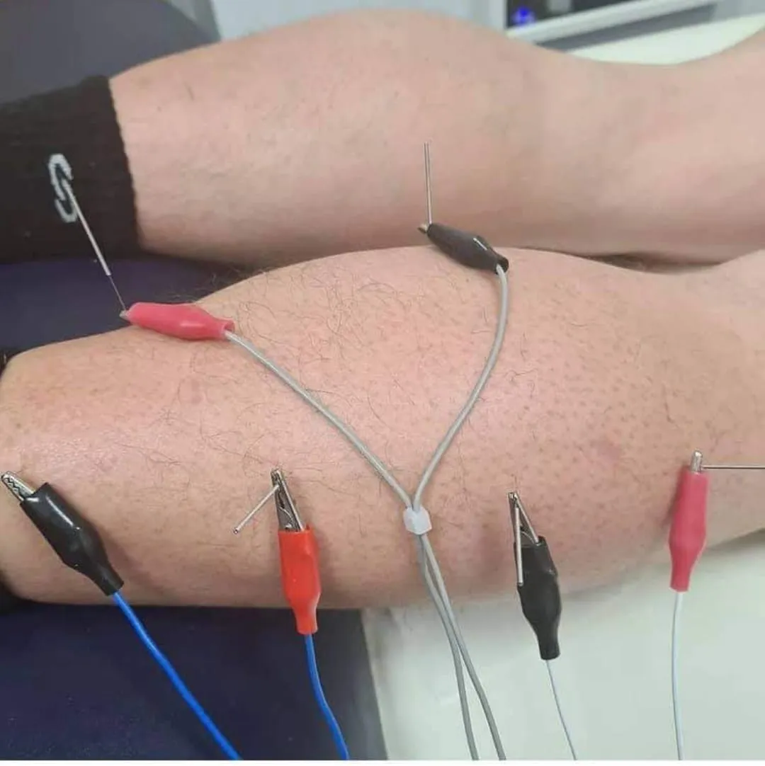 Acupuncture needles with electro-stimulation clips